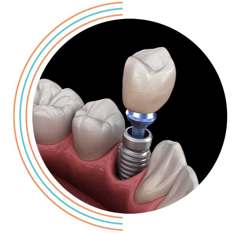 dental implant