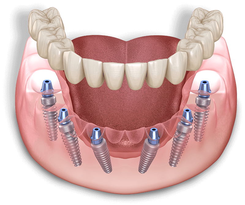 full arch model
