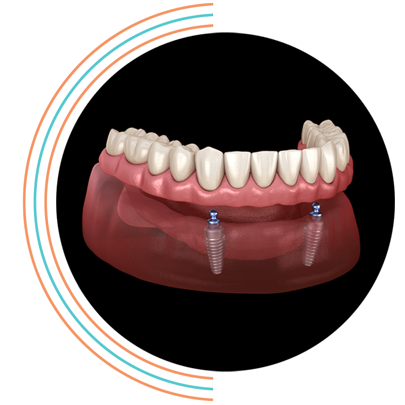 implant denture